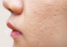 Can the Right Diet Get Rid of Acne?