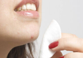 Acne - What Foods Cause Acne?